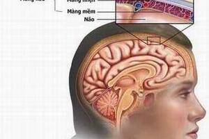 Bệnh viêm màng não mô cầu có phòng được không?
