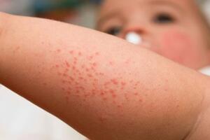 Xử lý bệnh da thường gặp ở trẻ nhỏ