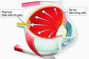 Bệnh glôcôm: chữa sớm để tránh mù lòa