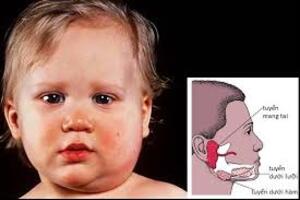 Trẻ bị quai bị, lớn dễ vô sinh