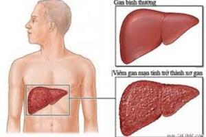 Biến chứng nguy hiểm của viêm gan B mạn tính