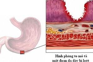 Dấu hiệu loét đường tiêu hóa