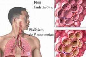 Thời tiết giao mùa: Cảnh giác viêm phổi cộng đồng