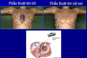 Lần đầu tiên phẫu thuật nội soi tim thành công