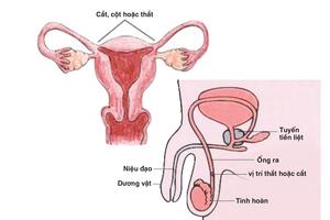 Triệt sản nam và triệt sản nữ