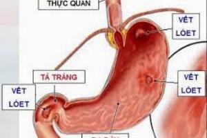 Phòng ngừa viêm loét dạ dày-tá tràng