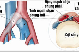 Suy tĩnh mạch chi dưới do hội chứng chèn ép tĩnh mạch chậu