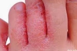 Điều trị các bệnh ngoài da mùa mưa lũ