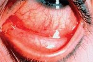 Cách ngừa đau mắt đỏ hiệu quả