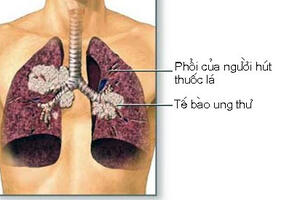 Một số thông tin cơ bản về ung thư phổi