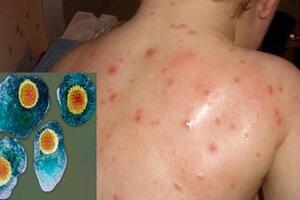 Bệnh truyền nhiễm trong mùa đông xuân và vắc-xin phòng bệnh