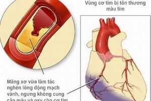 Khuyến cáo đặc biệt khi dùng thuốc điều trị nhồi máu cơ tim