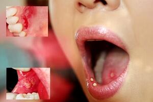 Làm gì khi bị loét miệng.