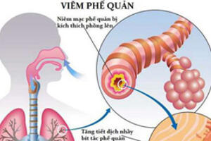 Viêm phế quản cấp