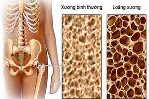 Phòng và điều trị loãng xương do corticoid