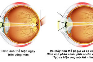 Lão thị: Sử dụng kính thế nào cho đúng?