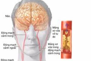 Dấu hiệu sớm thiếu máu não