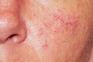 Lạm dụng thuốc chứa corticoid: Hậu quả khó khắc phục