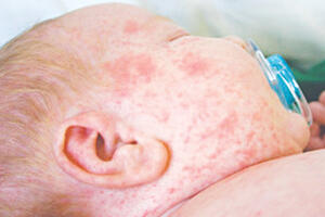 Những ngộ nhận về tiêm chủng