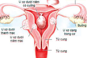 Nhận biết u xơ tử cung