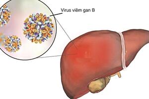 Chẩn đoán và điều trị viêm gan B theo hướng dẫn mới nhất của Bộ Y tế