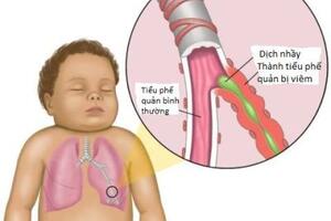 Phòng bệnh tai mũi họng ở trẻ em.