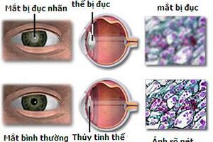 Chăm sóc mắt sau phẫu thuật  Đục thủy tinh thể