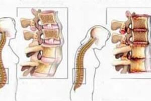 Cách phòng ngừa bệnh xương khớp ở người cao tuổi