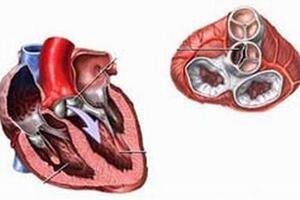 Thấp tim ở trẻ nhỏ: Bệnh nguy hiểm nhưng phòng ngừa được