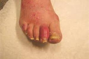 Bệnh  khớp vẩy nến  (Psoriatic arthritis)