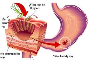 Thuốc diệt trừ H.Pylori ở dạ dày: Dùng sai, hại thân