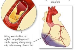 Chủ động phòng ngừa tai biến mạch máu não