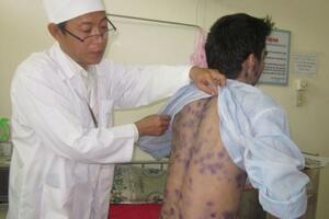 Dùng thuốc trị thủy đậu: Cẩn trọng để tránh biến chứng