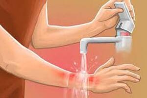 Sơ cứu bỏng lửa, nước sôi