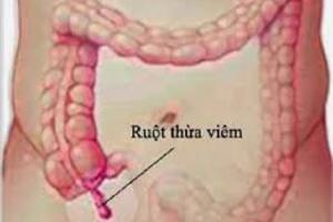 Dấu hiệu viêm ruột thừa?