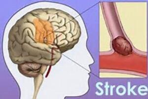 Chẩn đoán và xử trí đột quỵ