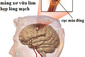 Thuốc làm tiêu cục máu đông trong nhồi máu não
