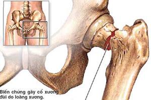Thuốc điều trị loãng xương - Cần dùng liên tục