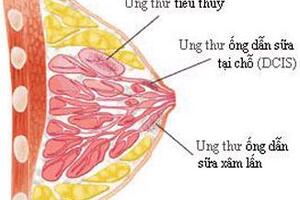 Phát hiện sớm ung thư vú: Nâng cao hiệu quả điều trị