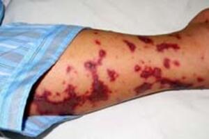 Hai người tử vong vì ăn tiết canh lợn