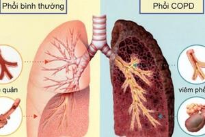 Bệnh phổi tắc nghẽn mạn tính đứng thứ ba trong các nguyên nhân  gây tử vong trên toàn cầu