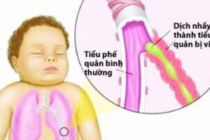 Ðề phòng viêm tiểu phế quản ở trẻ nhỏ