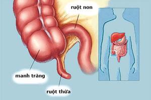 Ruột thừa đôi - Bệnh lý nguy hiểm