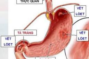 Cảnh giác với bất lợi của một số loại thuốc thường dùng