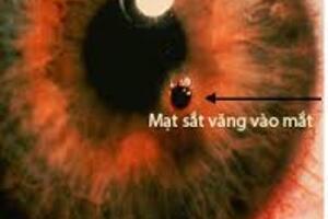 Xử trí cấp cứu chấn thương mắt