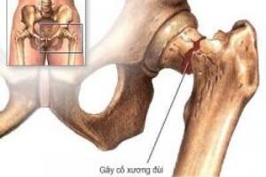 Phòng chống nguy cơ loãng xương ở người cao tuổi