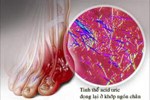 Cẩn trọng với tăng acid uric máu