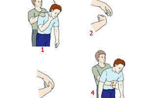 Xử trí dị vật đường thở.