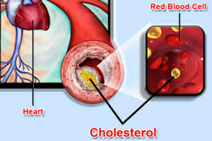 Thận trọng với thuốc hạ mỡ máu nhóm statin