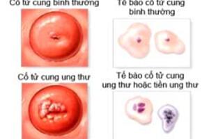 Dự phòng toàn diện ung thư cổ tử cung